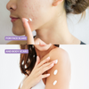 Woman pointing to face and body with scars, indicating product use for scarring.