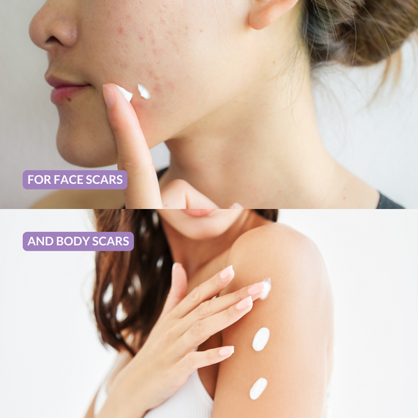 Woman pointing to face and body with scars, indicating product use for scarring.